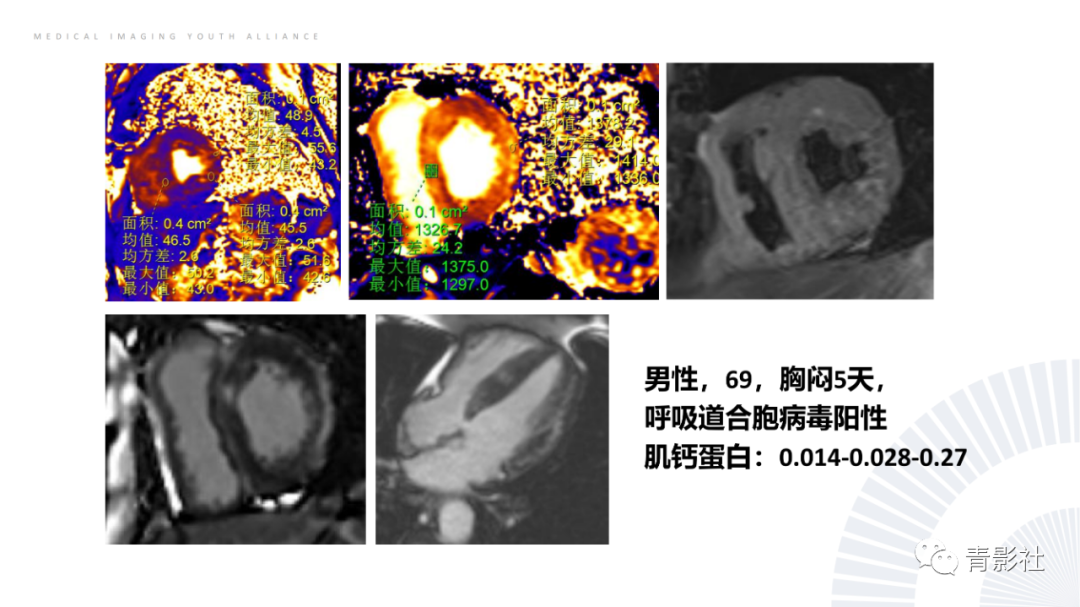 影像PPT - 【PPT】CMR在非冠状动脉阻塞性急性心肌损伤中的价值-26