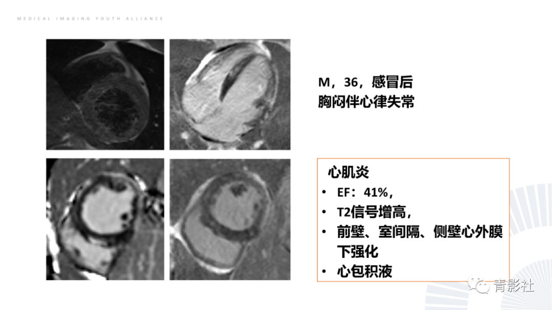 影像PPT - 【PPT】CMR在非冠状动脉阻塞性急性心肌损伤中的价值-27
