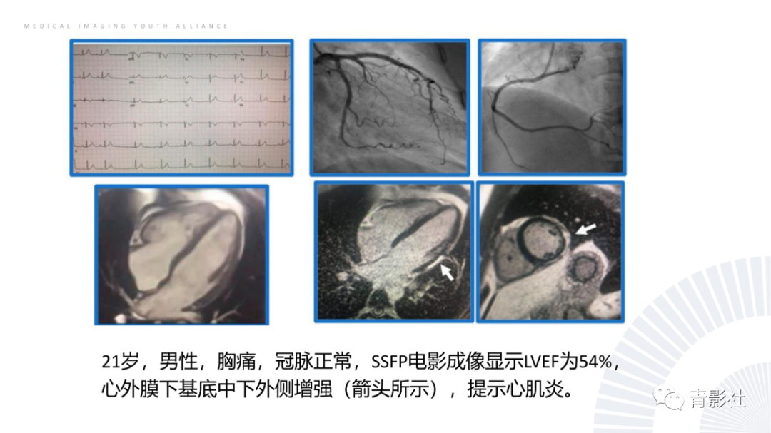 影像PPT - 【PPT】CMR在非冠状动脉阻塞性急性心肌损伤中的价值-28