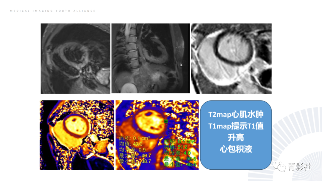 影像PPT - 【PPT】CMR在非冠状动脉阻塞性急性心肌损伤中的价值-29