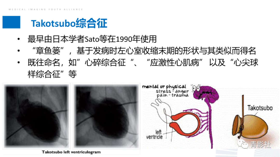 影像PPT - 【PPT】CMR在非冠状动脉阻塞性急性心肌损伤中的价值-31