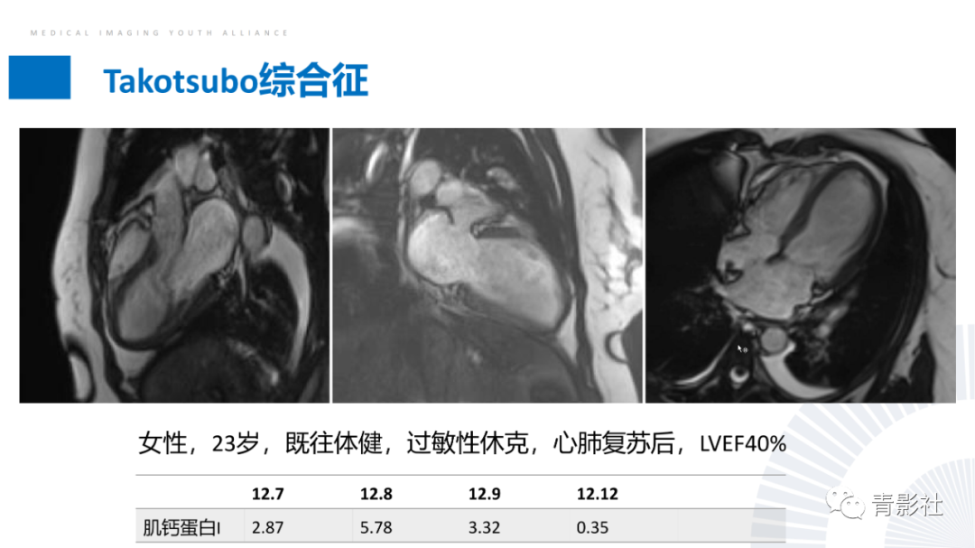 影像PPT - 【PPT】CMR在非冠状动脉阻塞性急性心肌损伤中的价值-32
