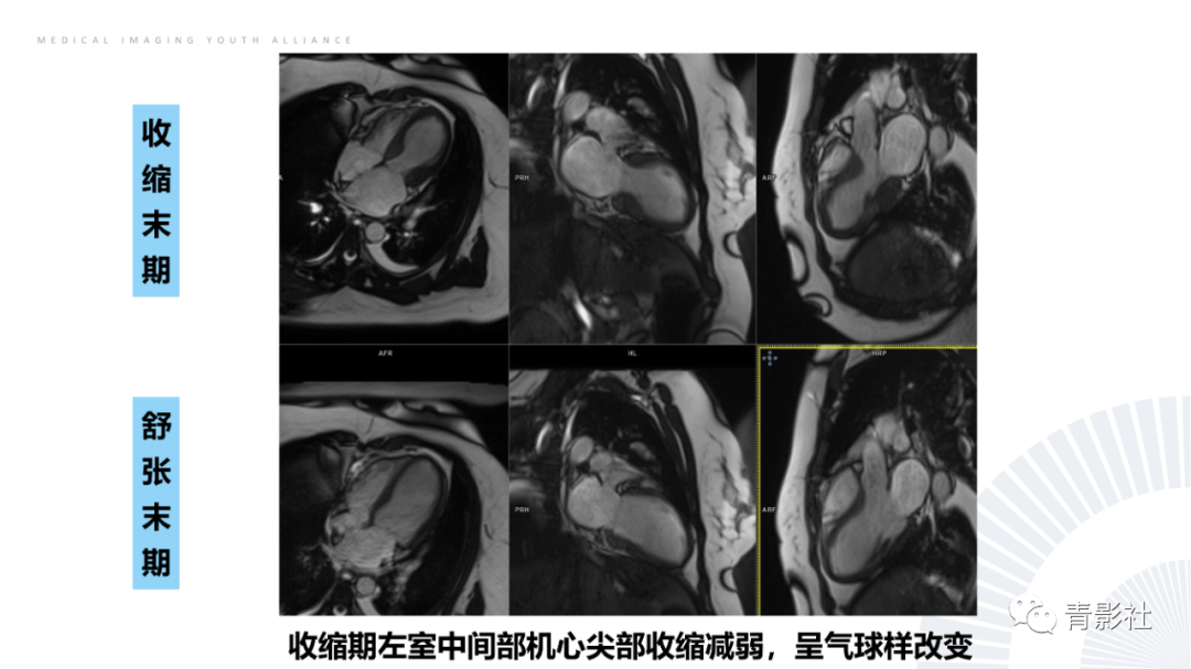 影像PPT - 【PPT】CMR在非冠状动脉阻塞性急性心肌损伤中的价值-33