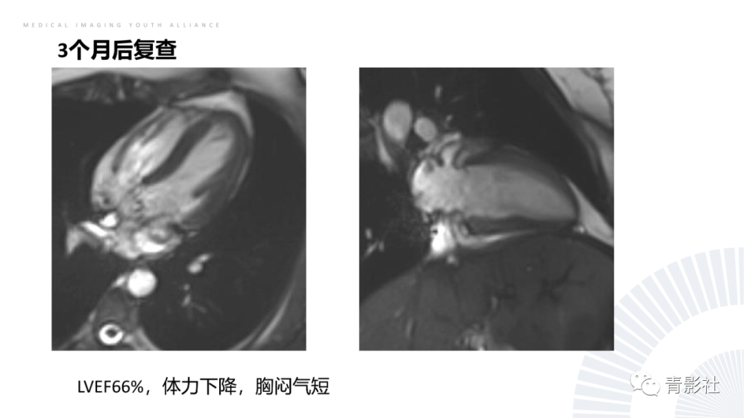 影像PPT - 【PPT】CMR在非冠状动脉阻塞性急性心肌损伤中的价值-36