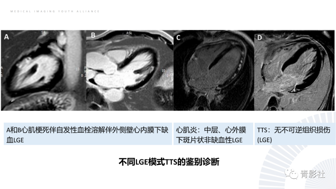 影像PPT - 【PPT】CMR在非冠状动脉阻塞性急性心肌损伤中的价值-48