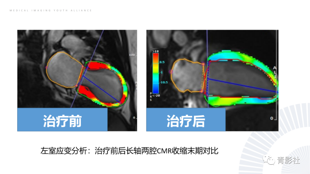 影像PPT - 【PPT】CMR在非冠状动脉阻塞性急性心肌损伤中的价值-50