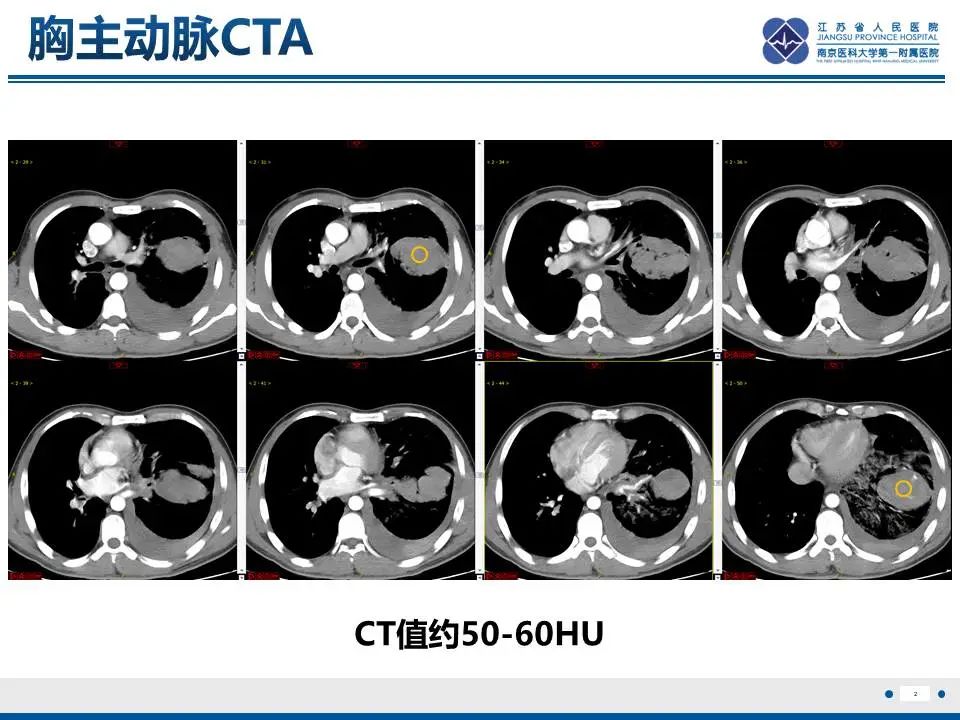 影像PPT - 【PPT】异常体循环供血左肺下叶基底段-3