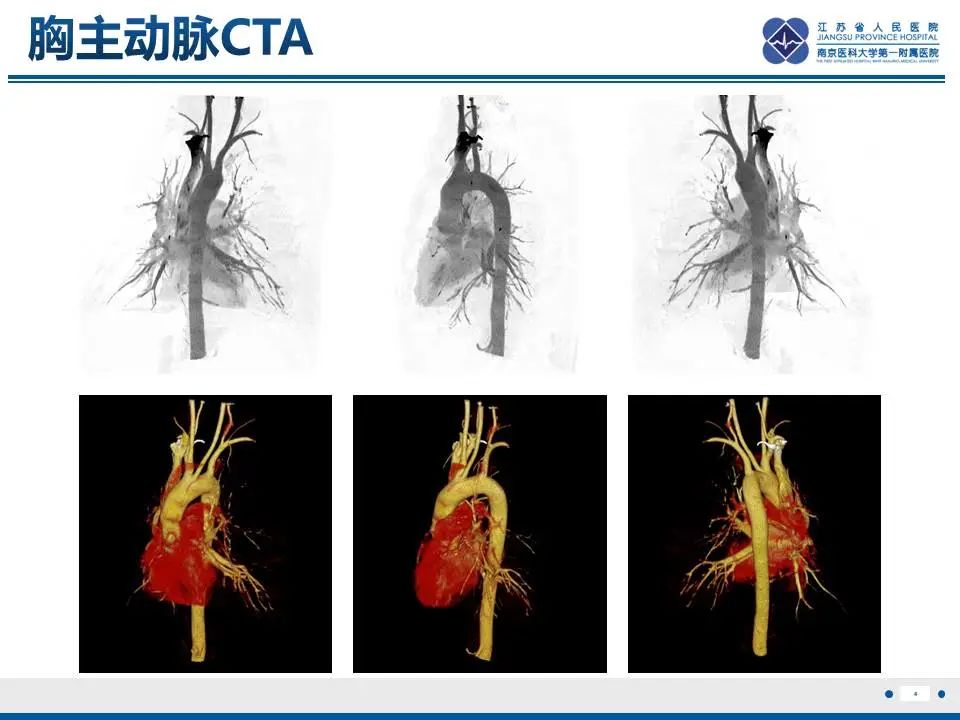 影像PPT - 【PPT】异常体循环供血左肺下叶基底段-5