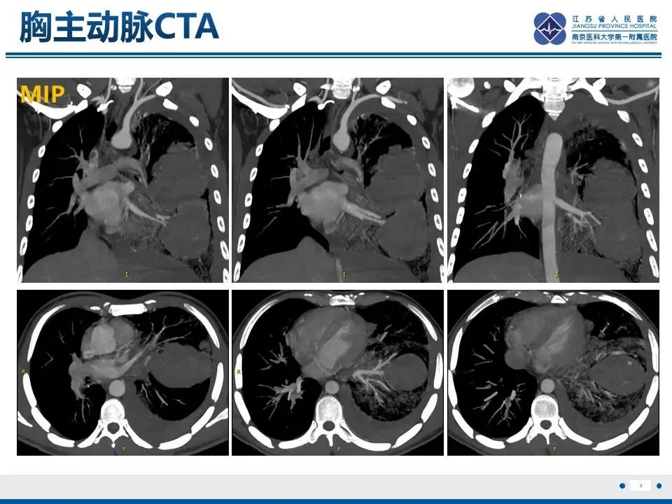 影像PPT - 【PPT】异常体循环供血左肺下叶基底段-4