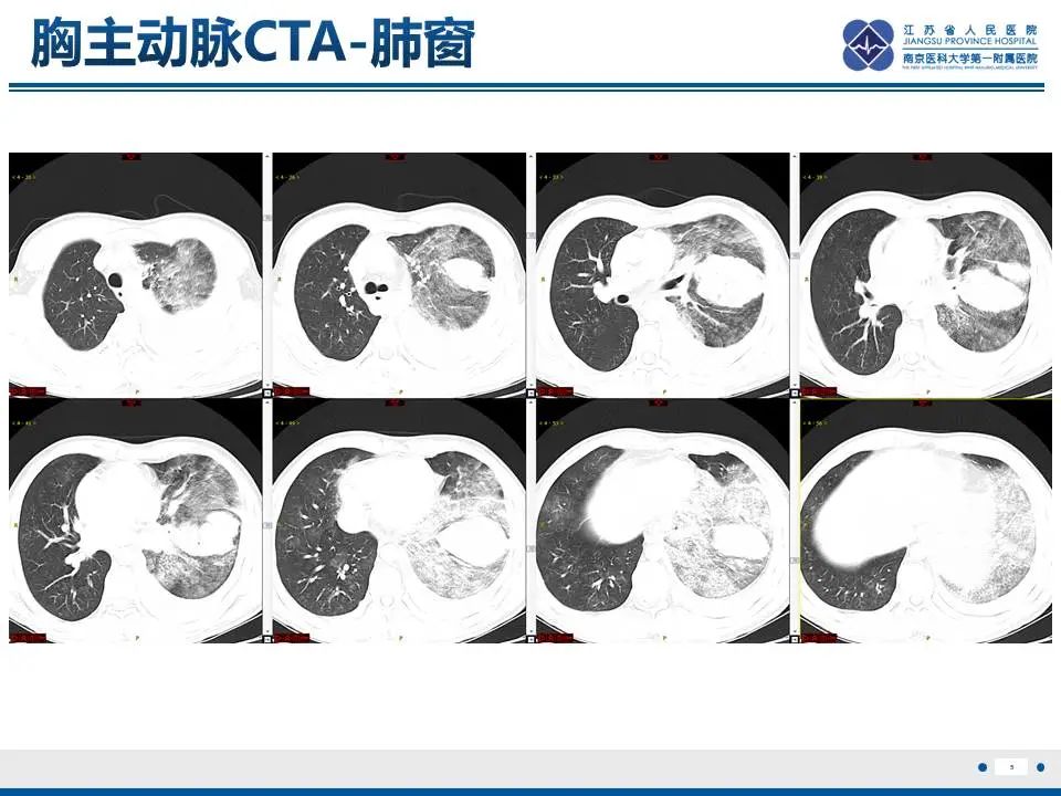 影像PPT - 【PPT】异常体循环供血左肺下叶基底段-6