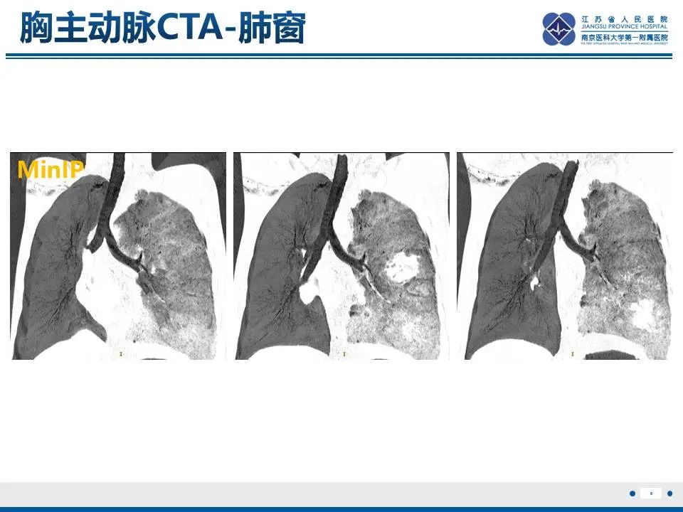 影像PPT - 【PPT】异常体循环供血左肺下叶基底段-7