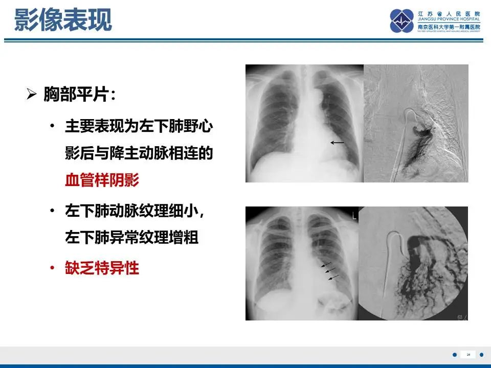 影像PPT - 【PPT】异常体循环供血左肺下叶基底段-25