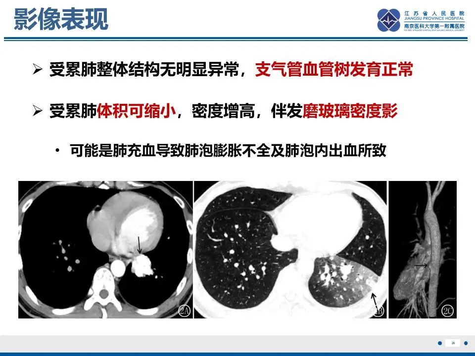 影像PPT - 【PPT】异常体循环供血左肺下叶基底段-29