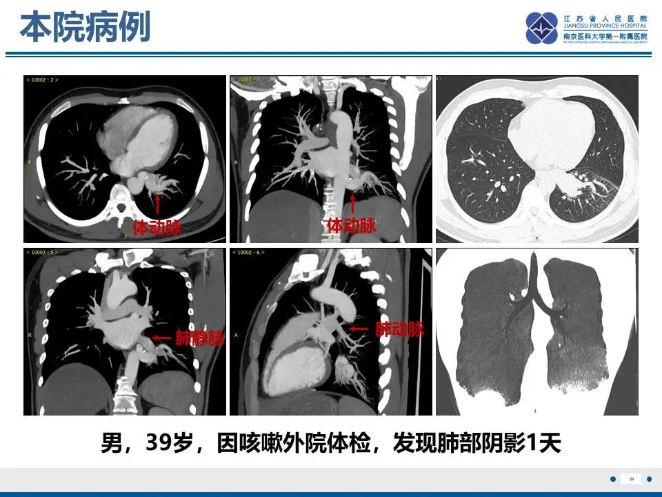 影像PPT - 【PPT】异常体循环供血左肺下叶基底段-30