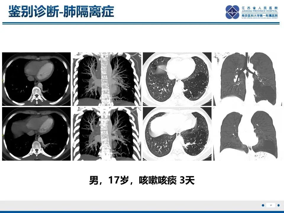 影像PPT - 【PPT】异常体循环供血左肺下叶基底段-32
