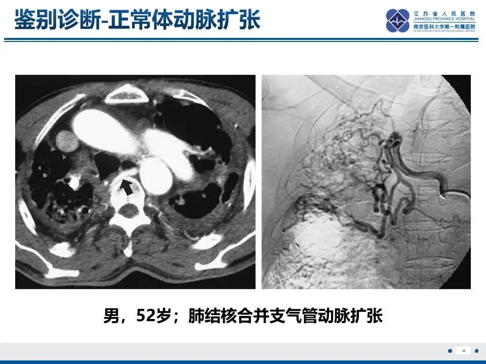 影像PPT - 【PPT】异常体循环供血左肺下叶基底段-36