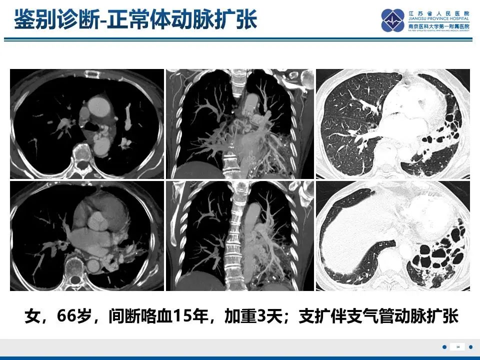 影像PPT - 【PPT】异常体循环供血左肺下叶基底段-35