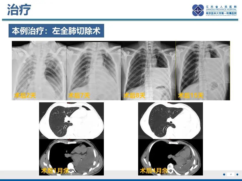 影像PPT - 【PPT】异常体循环供血左肺下叶基底段-38