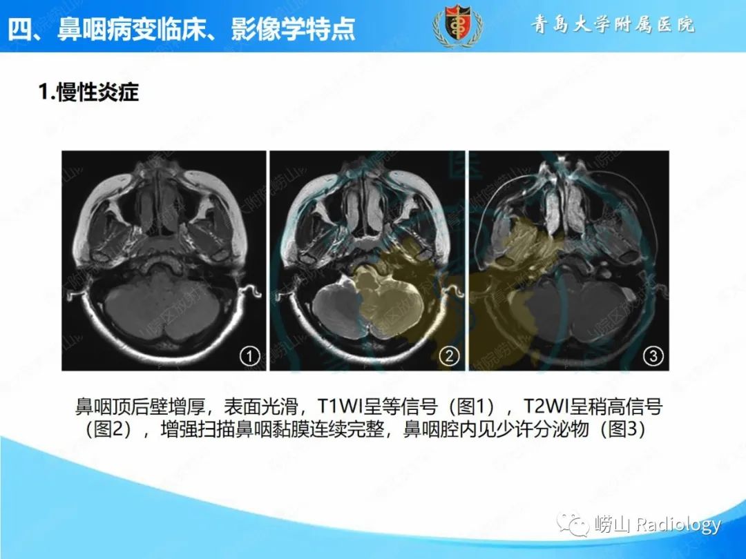 影像PPT - 【PPT】鼻咽病变的影像诊断思路-15