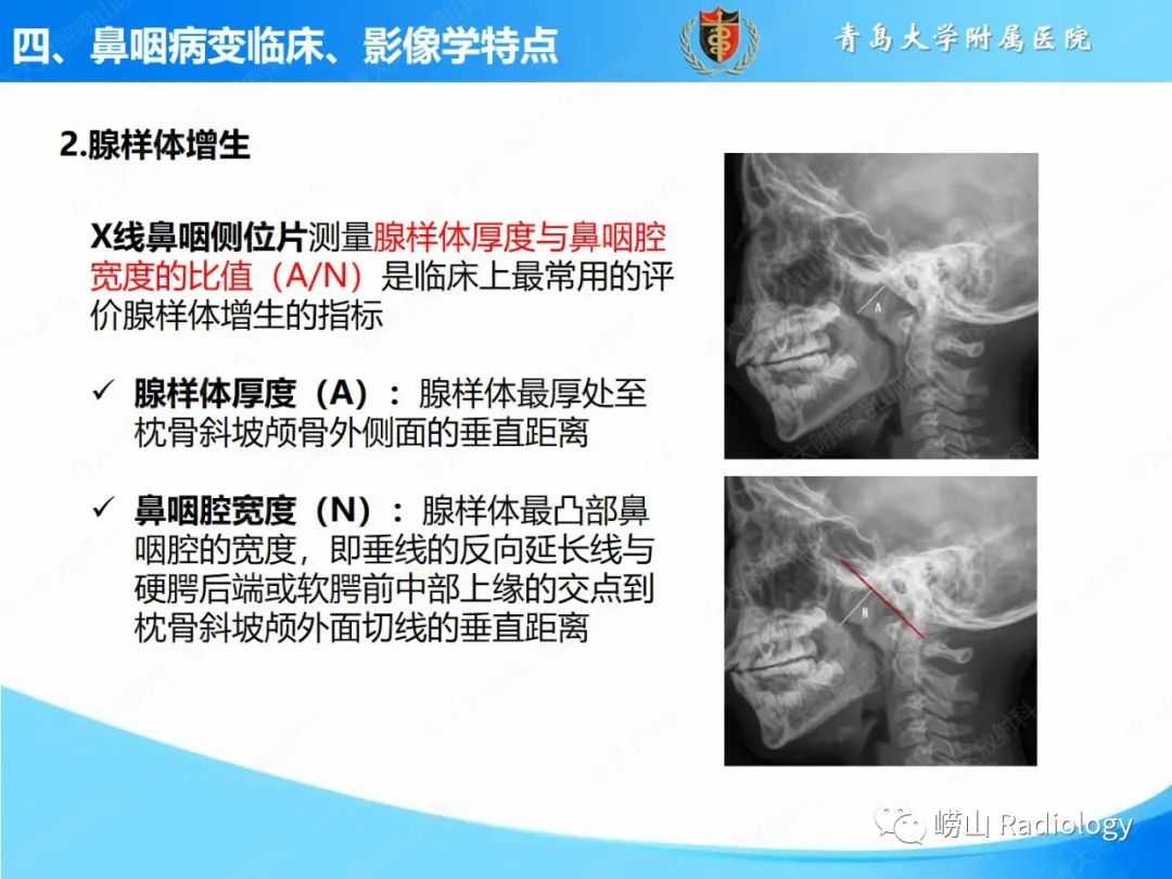 影像PPT - 【PPT】鼻咽病变的影像诊断思路-17