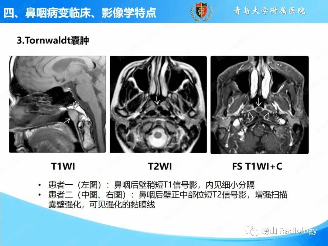 影像PPT - 【PPT】鼻咽病变的影像诊断思路-23