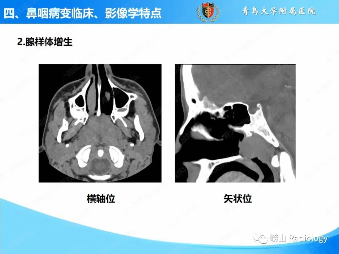 影像PPT - 【PPT】鼻咽病变的影像诊断思路-20