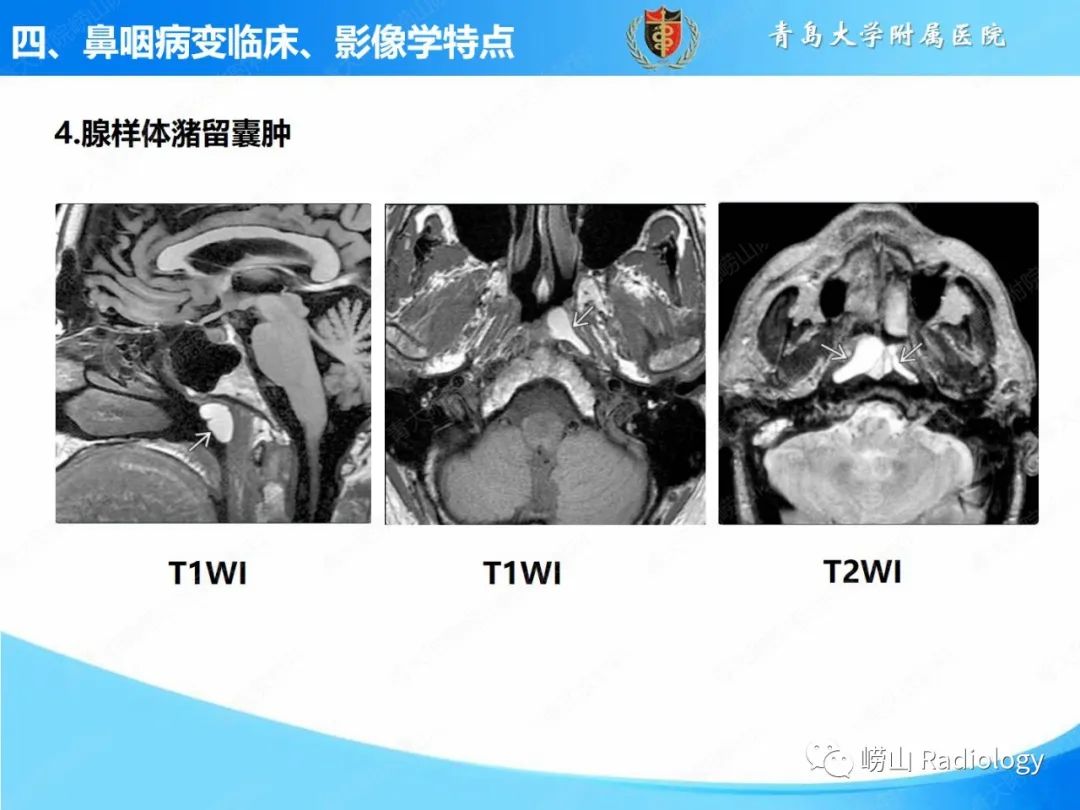影像PPT - 【PPT】鼻咽病变的影像诊断思路-25