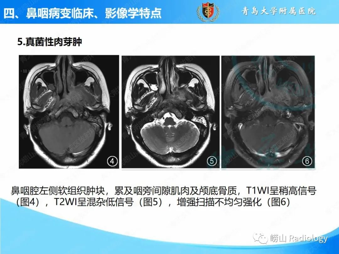 影像PPT - 【PPT】鼻咽病变的影像诊断思路-27