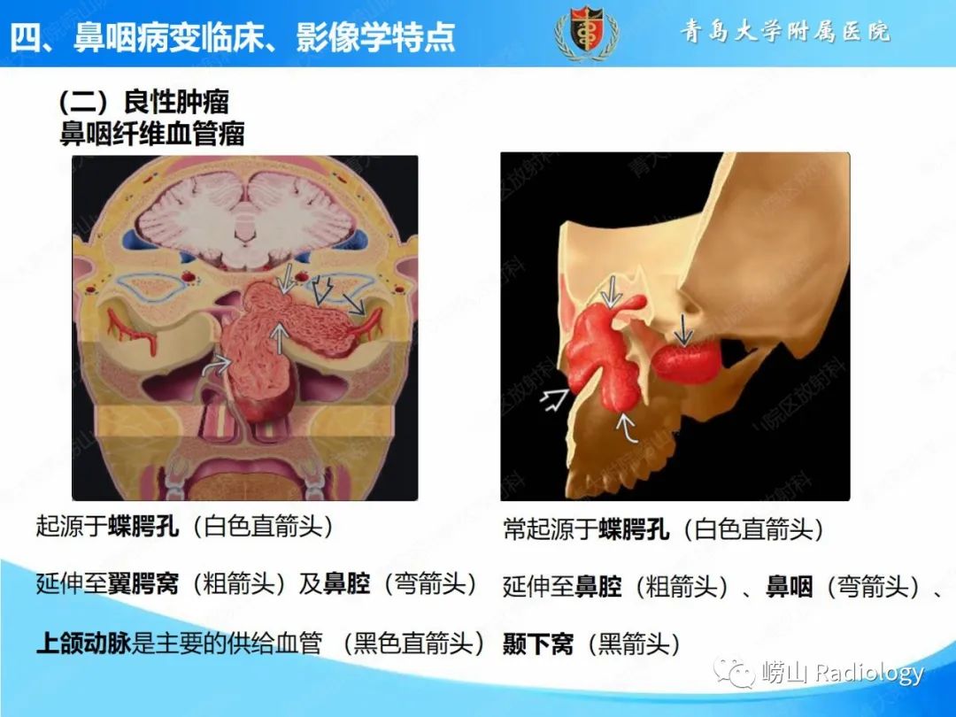 影像PPT - 【PPT】鼻咽病变的影像诊断思路-30