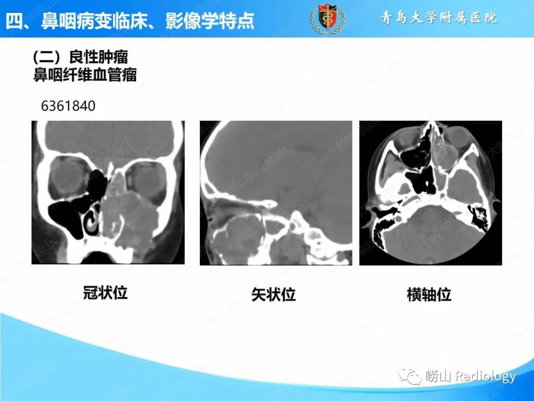 影像PPT - 【PPT】鼻咽病变的影像诊断思路-32