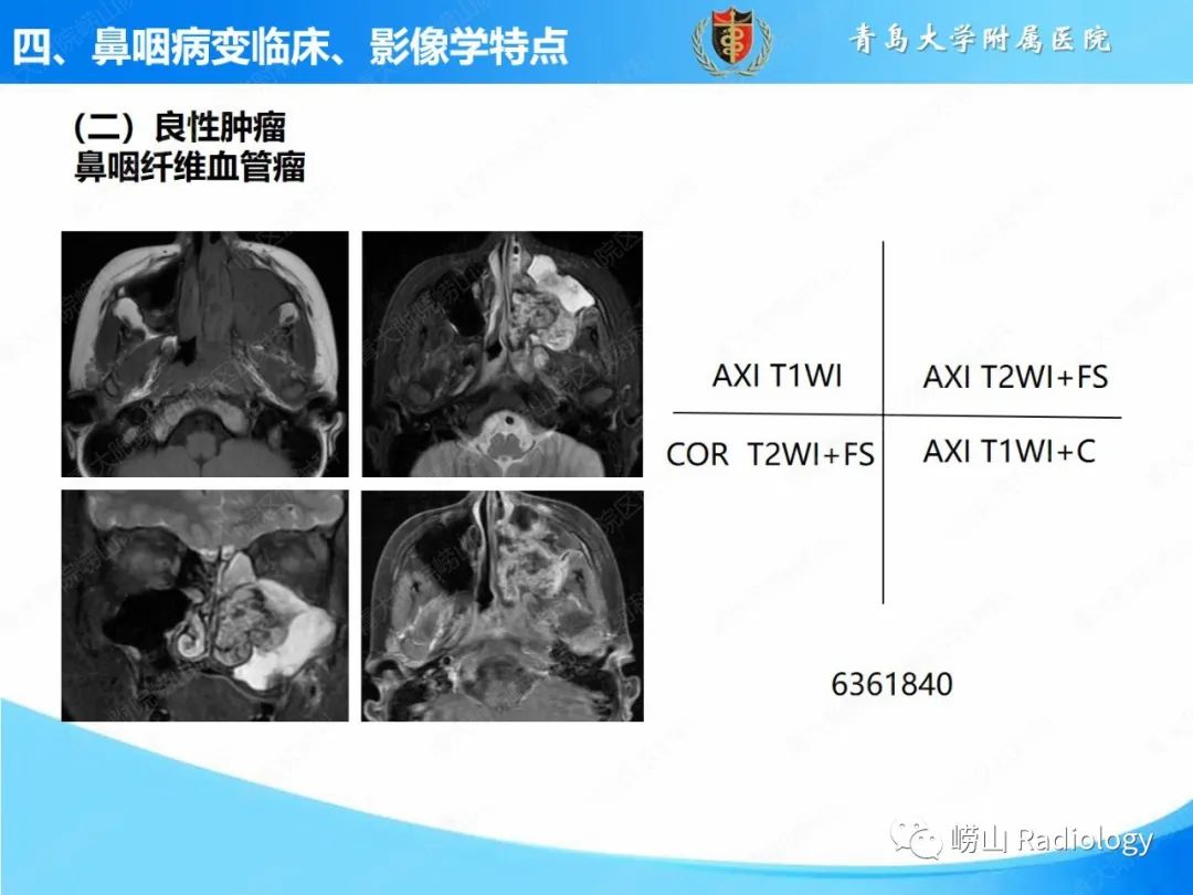 影像PPT - 【PPT】鼻咽病变的影像诊断思路-33