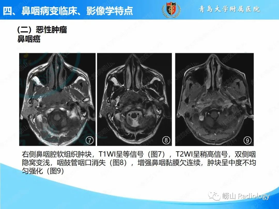 影像PPT - 【PPT】鼻咽病变的影像诊断思路-36