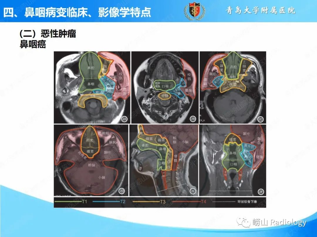 影像PPT - 【PPT】鼻咽病变的影像诊断思路-38