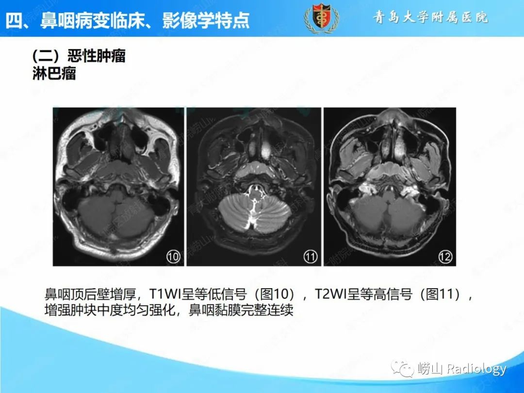 影像PPT - 【PPT】鼻咽病变的影像诊断思路-43