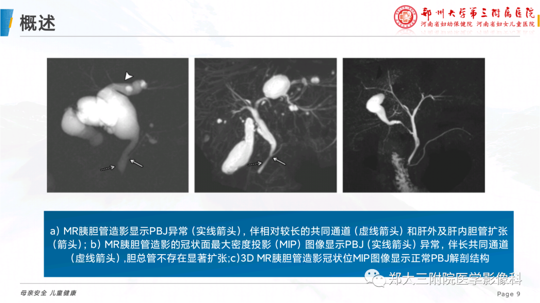 影像PPT - 【PPT】儿童胰胆管合流异常影像表现-9