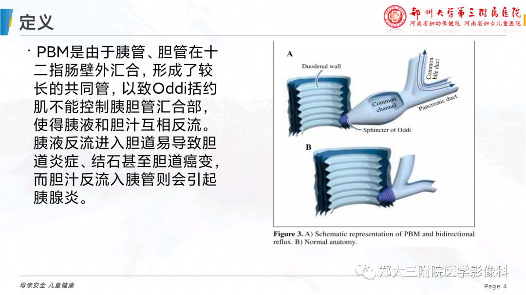 影像PPT - 【PPT】儿童胰胆管合流异常影像表现-4