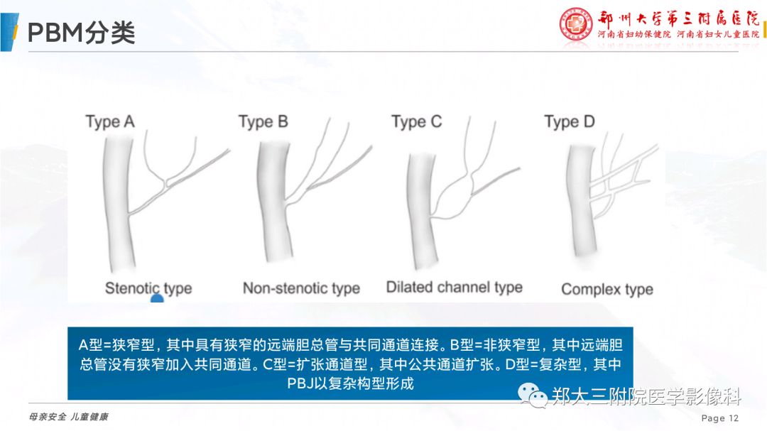 影像PPT - 【PPT】儿童胰胆管合流异常影像表现-12