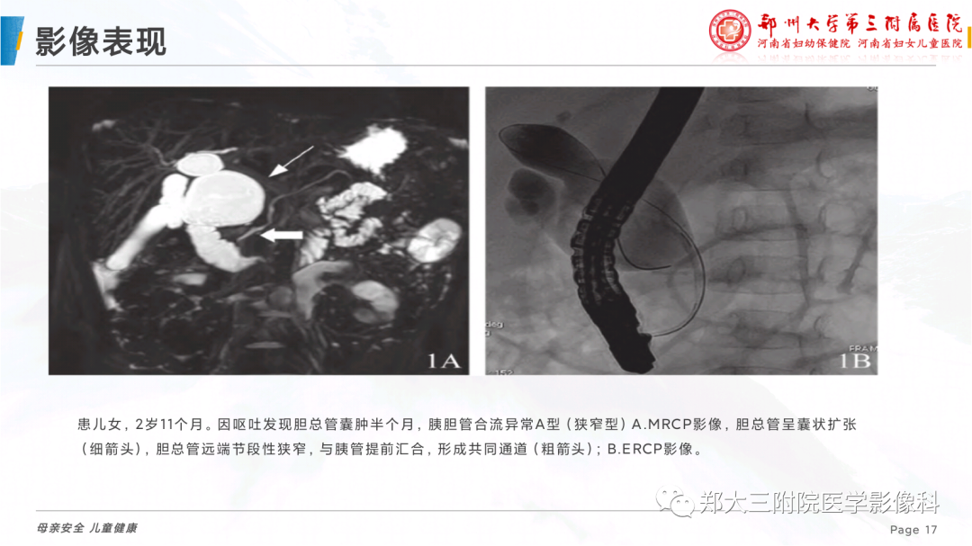 影像PPT - 【PPT】儿童胰胆管合流异常影像表现-17