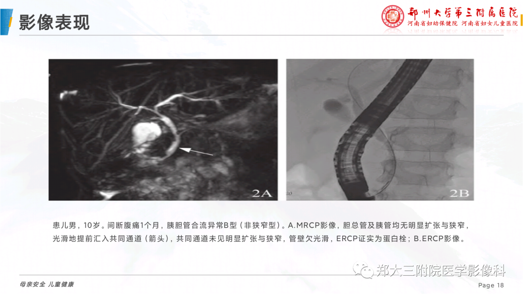 影像PPT - 【PPT】儿童胰胆管合流异常影像表现-18