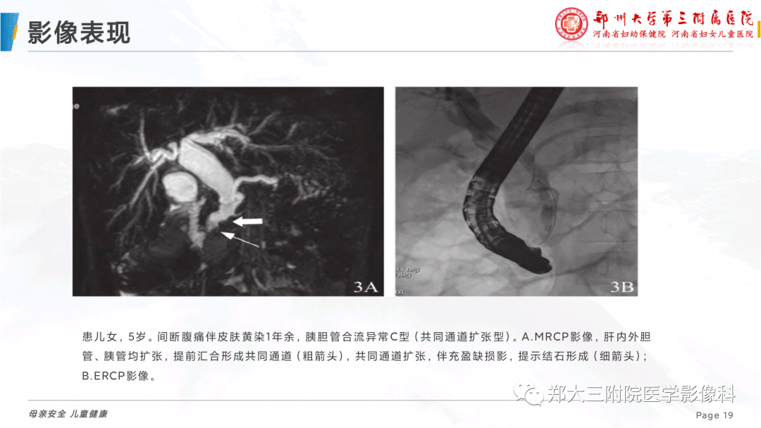 影像PPT - 【PPT】儿童胰胆管合流异常影像表现-19