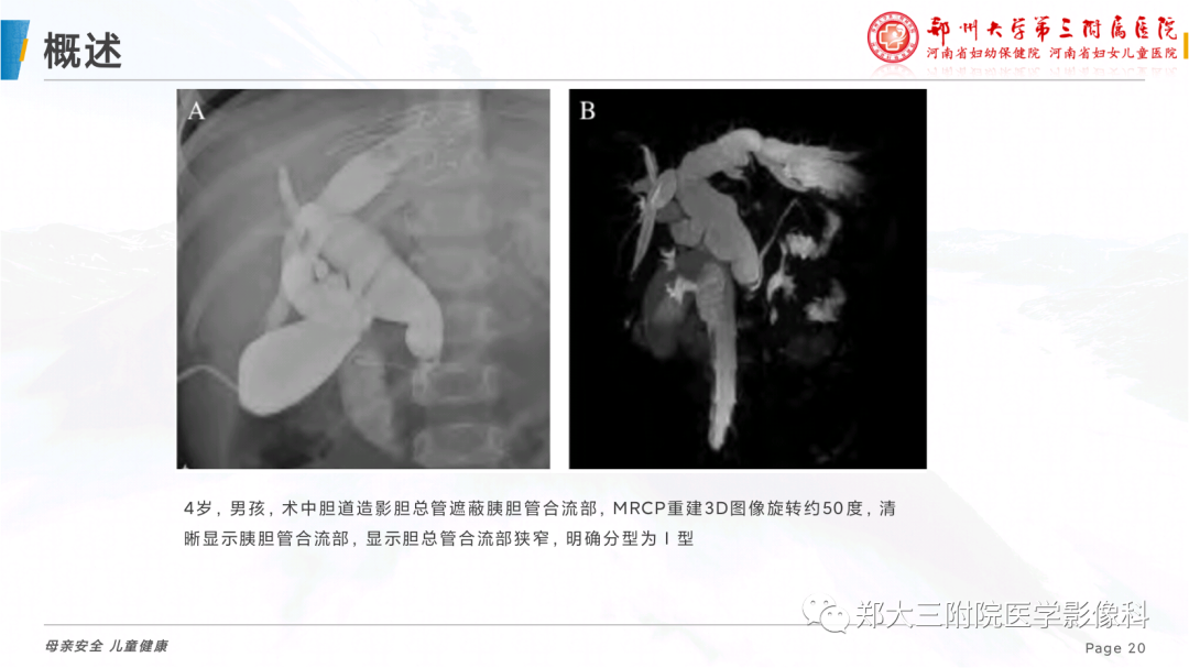 影像PPT - 【PPT】儿童胰胆管合流异常影像表现-20