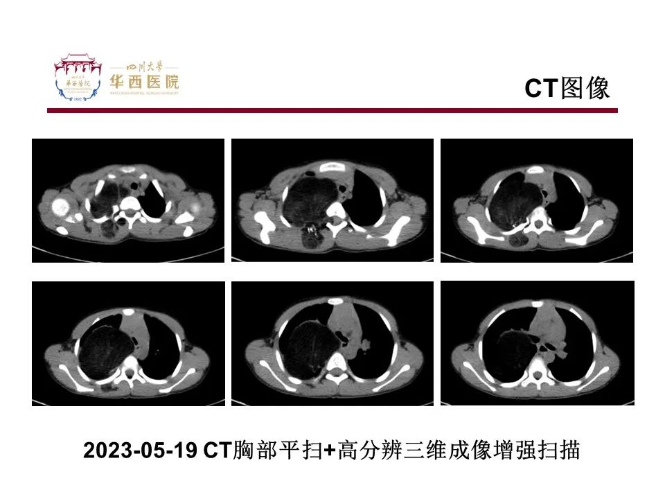 影像PPT - 【病例】脂肪母细胞瘤1例CT影像-4