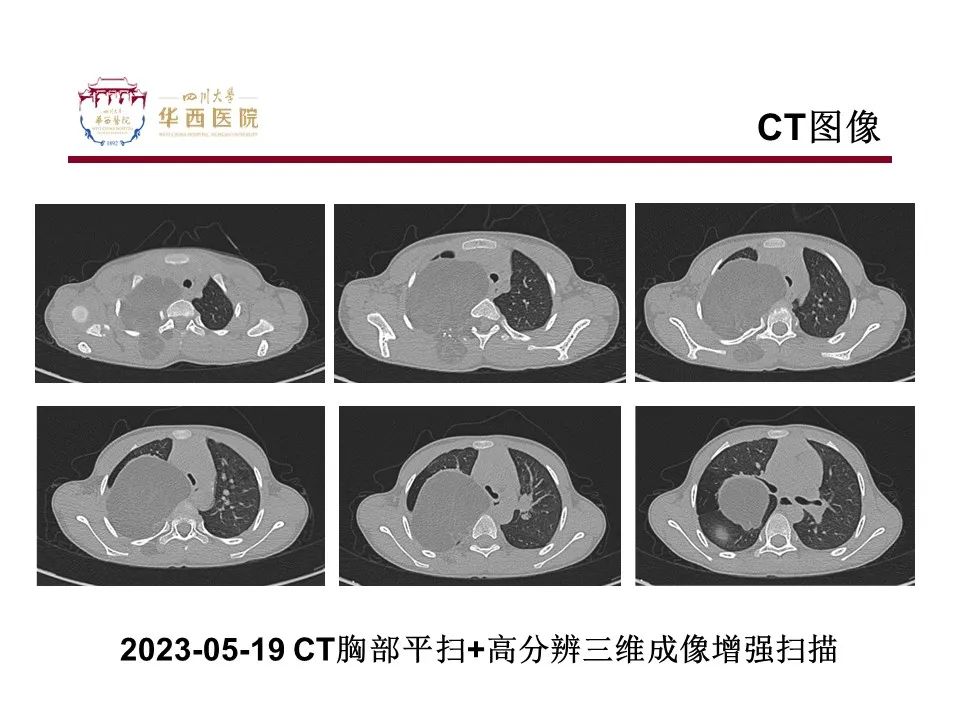 影像PPT - 【病例】脂肪母细胞瘤1例CT影像-3