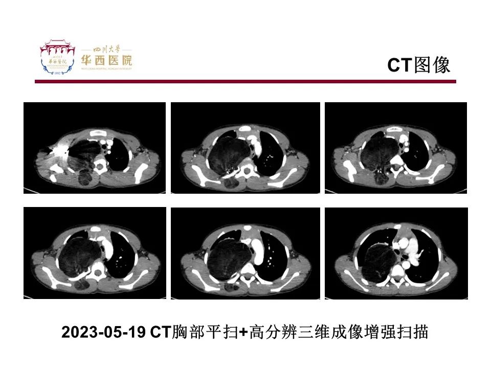 影像PPT - 【病例】脂肪母细胞瘤1例CT影像-5