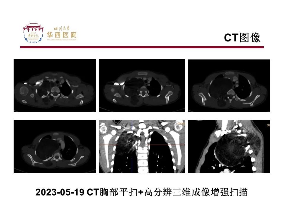 影像PPT - 【病例】脂肪母细胞瘤1例CT影像-6
