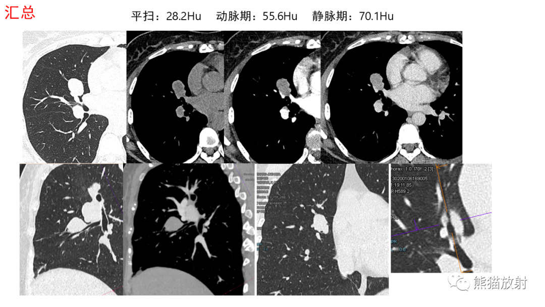 影像PPT - 【病例】肺典型类癌 VS 不典型类癌-3