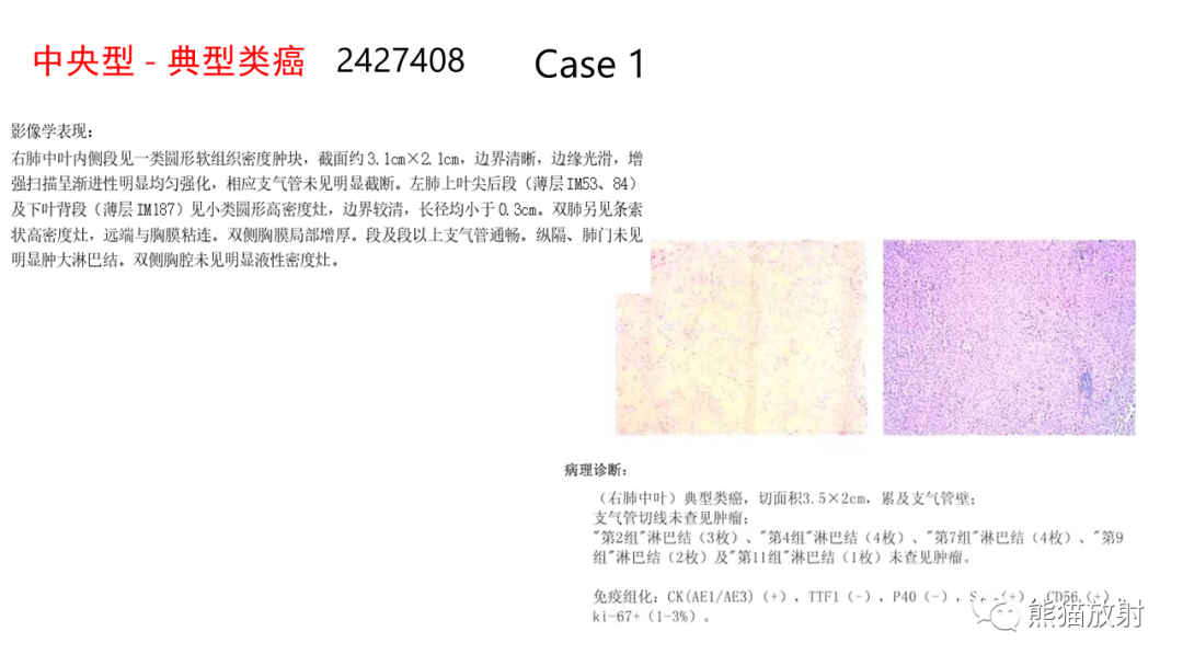 影像PPT - 【病例】肺典型类癌 VS 不典型类癌-11