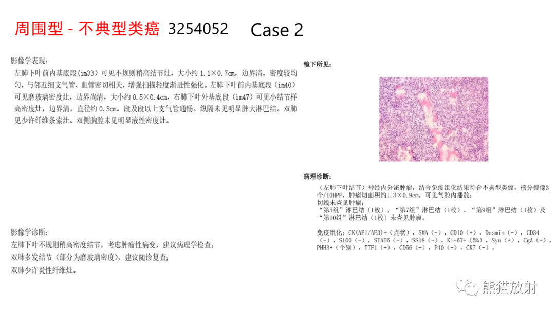 影像PPT - 【病例】肺典型类癌 VS 不典型类癌-12