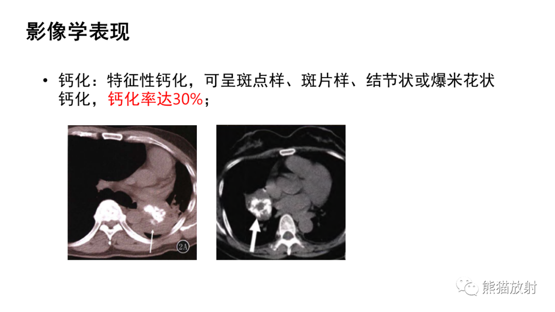 影像PPT - 【病例】肺典型类癌 VS 不典型类癌-20