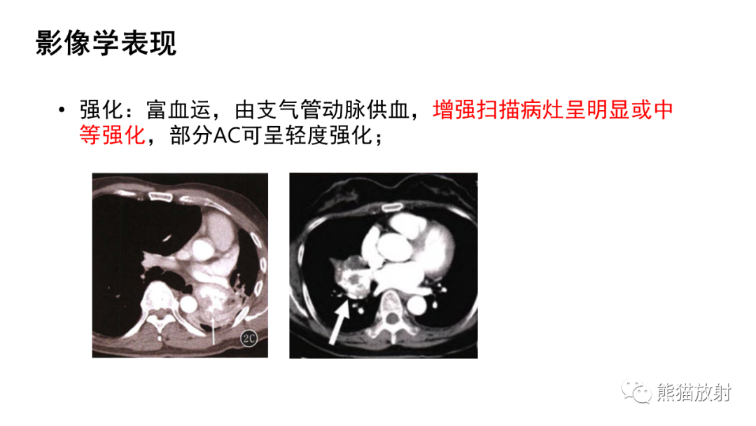 影像PPT - 【病例】肺典型类癌 VS 不典型类癌-21